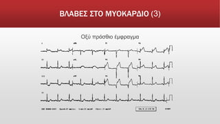 ΒΛΑΒΕΣ ΣΤΟ ΜΥΟΚΑΡΔΙΟ (3)
Οξύ πρόσθιο έμφραγμα
 