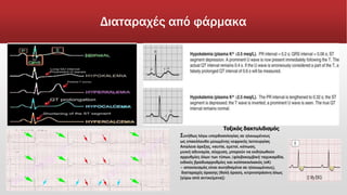 Διαταραχές από φάρμακα
Τοξικός δακτυλιδισμός
Συνήθως λόγω υπερδοσολογίας σε ηλικιωμένους
ως επακόλουθο μειωμένης νεφρικής λειτουργίας
Απώλεια όρεξης, ναυτία, εμετοί, κόπωση,
μυική αδυναμία, σύγχυση, μπορούν να εκδηλωθούν
αρρυθμίες όλων των τύπων, (φλεβοκομβική ταχυκαρδία,
ειδικές βραδυαρρυθμίες και κολποκοιλιακός (κΚ)
– αποκλεισμός είναι συνηθισμένα σε ηλικιωμένους),
διαταραχές όρασης (θολή όραση, κιτρινοπράσινη άλως
[γύρω από αντικείμενα])
 