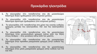 Προκάρδια ηλεκτρόδια
1. Το ηλεκτρόδιο «V1» τοποθετείται στο 4ο μεσοπλεύριο
διάστημα δεξιό ημιθωράκιο (στο στερνικό χείλος).
2. Το ηλεκτρόδιο «V2» τοποθετείται στο 4ο μεσοπλεύριο
διάστημα αριστερό ημιθωράκιο (στο στερνικό χείλος).
3. Το ηλεκτρόδιο «V3» τοποθετείται στο μέσο της νοητής ευθείας
γραμμής μεταξύ του ηλεκτροδίου «V2» και του ηλεκτροδίου
«V4».
4. Το ηλεκτρόδιο «V4» τοποθετείται στο 5ο μεσοπλεύριο
διάστημα στην μεσοκλειδική γραμμή (κάτω από την θηλή
στους άνδρες – στις γυναίκες κάτω από τον μαστό).
5. Το ηλεκτρόδιο «V5» τοποθετείται στο 5ο μεσοπλεύριο
διάστημα στην πρόσθια μασχαλιαία γραμμή (στην ευθεία της
V4).
6. Το ηλεκτρόδιο «V6» τοποθετείται στο 5ο μεσοπλεύριο
διάστημα στην μέση μασχαλιαία γραμμή (στην ευθεία των V4
και V5).
 