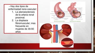 - Hay dos tipos de
enfermedad reno-vascular:
1. La ateroesclerosis
de la arteria renal
proximal.
2. La displasia
fibromuscular; mas
frecuente en
mujeres de 30-50
años
 