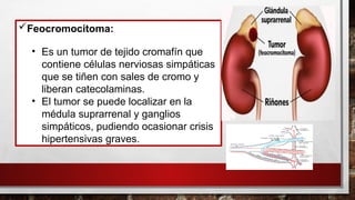 Feocromocitoma:
• Es un tumor de tejido cromafín que
contiene células nerviosas simpáticas
que se tiñen con sales de cromo y
liberan catecolaminas.
• El tumor se puede localizar en la
médula suprarrenal y ganglios
simpáticos, pudiendo ocasionar crisis
hipertensivas graves.
 