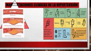 MANIFESTACIONES CLÍNICAS DE LA HIPERTENSIÓN
presenta
síntomas
,
se
relaciona
con los
efectos
a largo
plazo en
otros
órganos
dianas
RIÑONES, CORAZÓN, OJOS, Y
LOS VASOS SANGUÍNEOS
 
