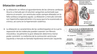 Dilatación cardiaca
● La dilatación se refiere al agrandamiento de las cámaras cardiacas.
Ocurre a menudo por el volumen sanguíneo aumentado que
retorna al corazón. Los ventrículos están siempre dilatados en la
falla cardiaca congestiva aguda. La dilatación a menudo coincide
con hipertrofia especialmente si la causa que la ha ocasionado es
crónica, así como en la hipertensión sistémica.
● La dilatación es característica de las cardiomiopatías en la cual la
separación de las trabéculas pueden coexistir con fibrosis
miocárdica. Usualmente la gran dilatación determina menor
poder contráctil. Lo inefectivo de la contracción ventricular
izquierda a menudo es llamada hipokinesia ventricular izquierda.
 