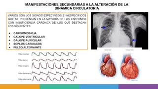 MANIFESTACIONES SECUNDARIAS A LA ALTERACIÓN DE LA
DINÁMICA CIRCULATORIA
VARIOS SON LOS SIGNOS ESPECÍFICOS E INESPECÍFICOS
QUE SE PRESENTAN EN LA MAYORÍA DE LOS ENFERMOS
CON INSUFICIENCIA CARDIACA DE LOS QUE DESTACAN
LOS SIGUIENTES:
● CARDIOMEGALIA
● GALOPE VENTRICULAR
● GALOPE AURICULAR
● SOPLOS CARDIACOS
● PULSO ALTERNANTE
 