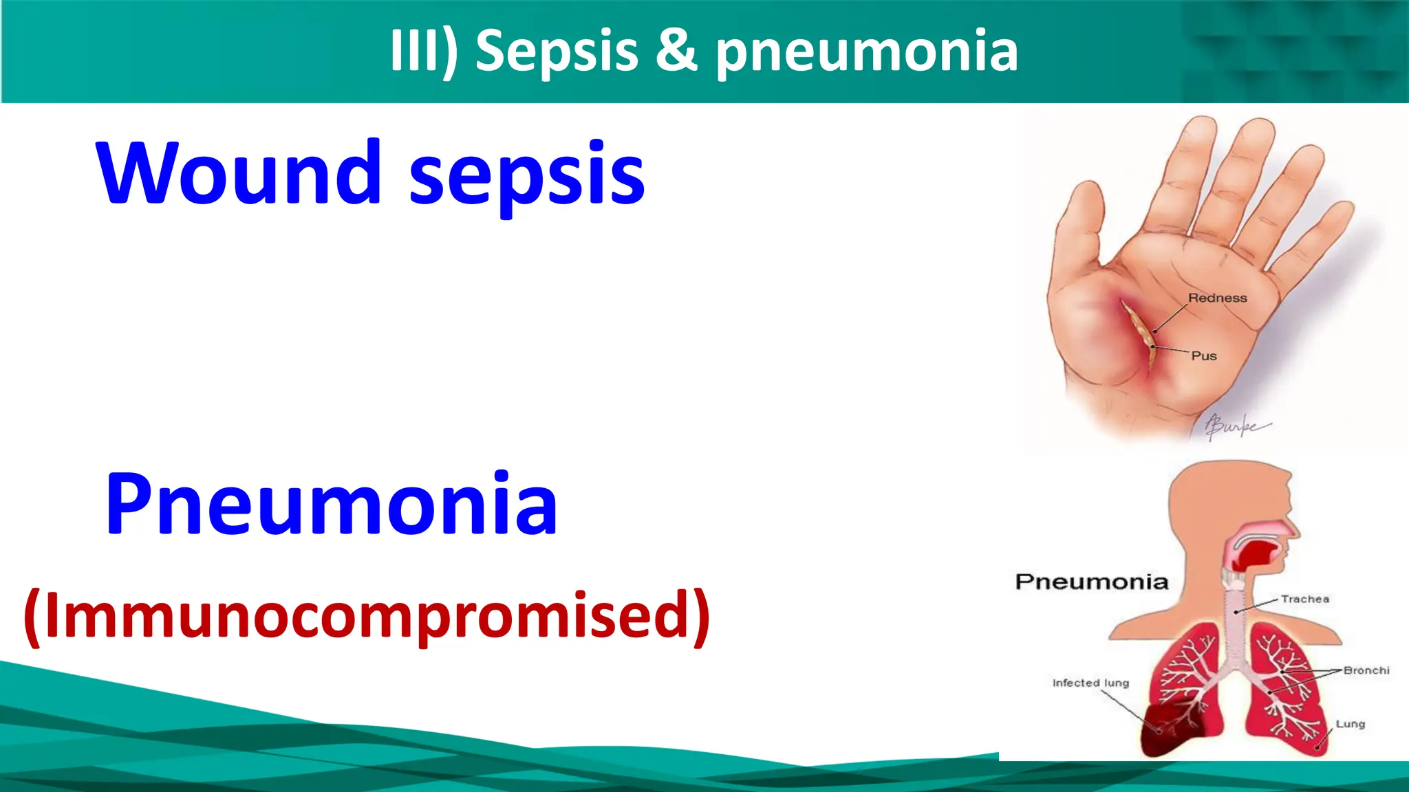 III) Sepsis & pneumonia
Wound sepsis
Pneumonia
(Immunocompromised)
 