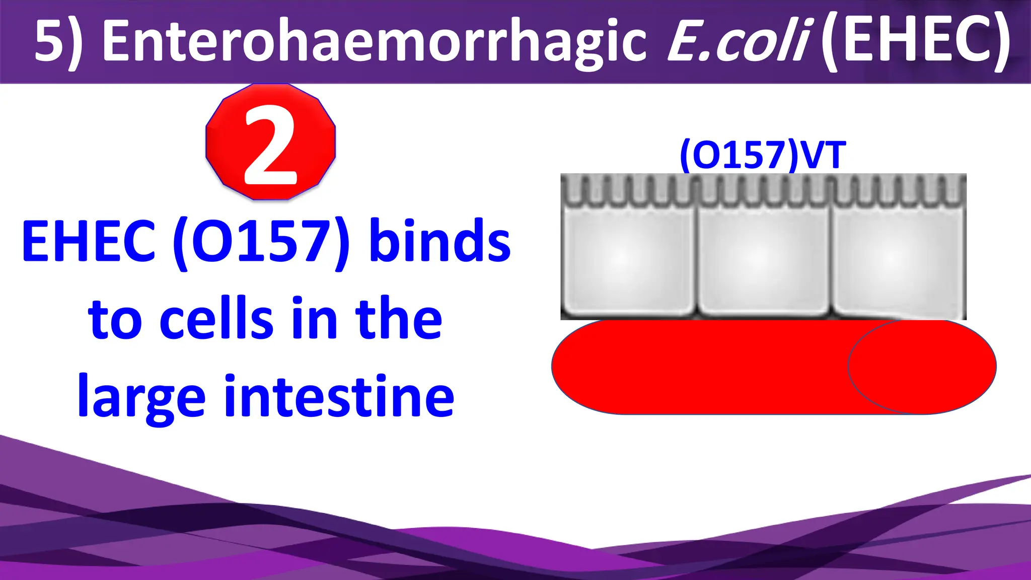 5) Enterohaemorrhagic E.coli (EHEC)
EHEC (O157) binds
to cells in the
large intestine
(O157)VT
2
 