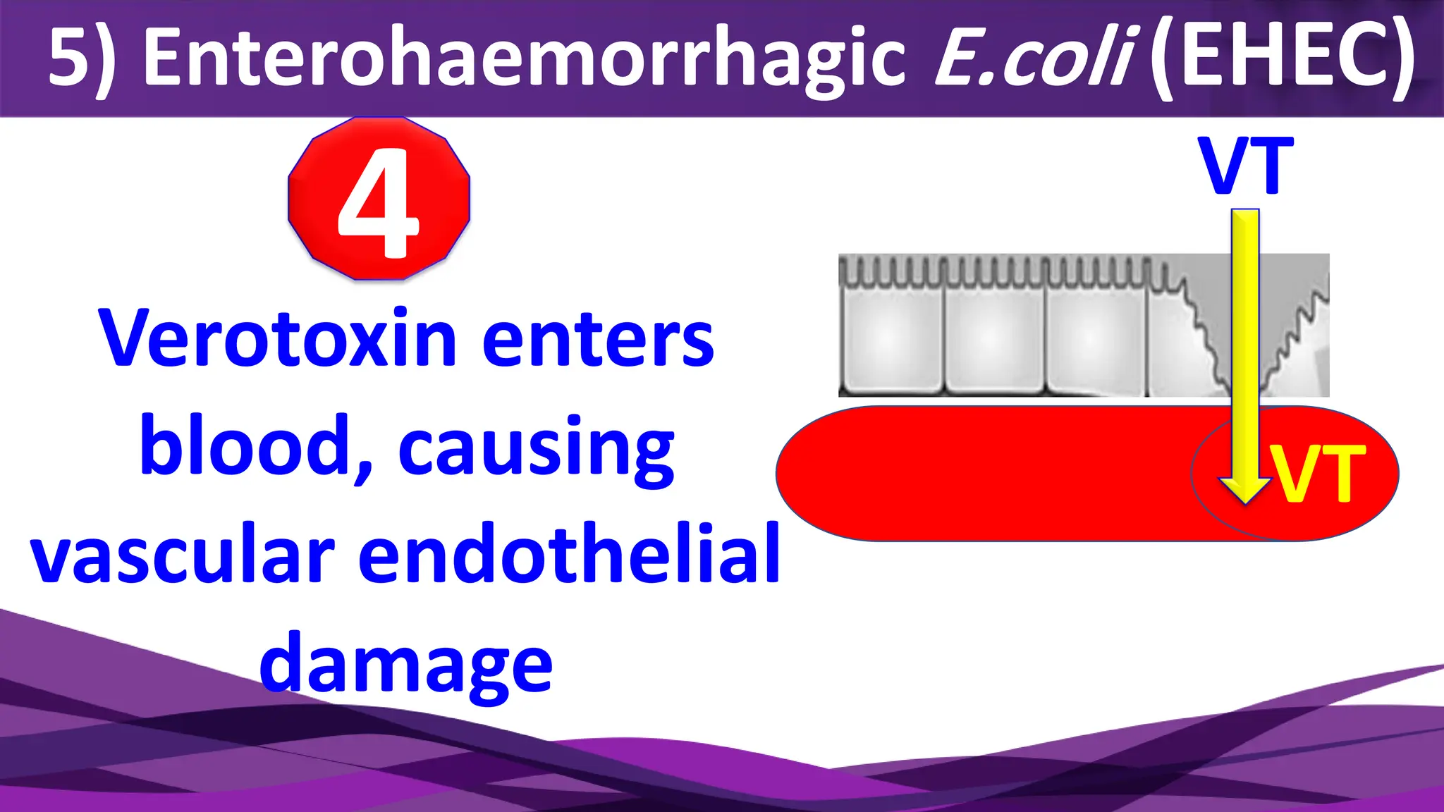5) Enterohaemorrhagic E.coli (EHEC)
Verotoxin enters
blood, causing
vascular endothelial
damage
4 VT
VT
 