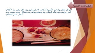 ( ‫األسبوع‬ ‫قبل‬ ‫يولد‬ ‫طفل‬ ‫كل‬ ‫هو‬
37
)
‫األطفال‬ ‫من‬ ‫بكثير‬ ‫اقل‬ ‫وزنه‬ ‫ويكون‬ ‫الحمل‬ ‫من‬
.
‫عدم‬ ‫بسبب‬ ‫صحية‬ ‫ل‬-
‫ك‬‫مشا‬ ‫من‬ ‫يعانون‬ ‫لهم‬-
‫ع‬‫يج‬ ‫مما‬ ‫الحمل‬ ‫تمام‬ ‫في‬ ‫يولدون‬ ‫الذين‬
‫أعضاهم‬ ‫تخلق‬ ‫اكتمال‬.
" "
‫المبستر‬ ‫الخديج‬ ‫الطفل‬
 