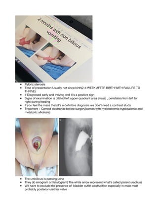 ● Pyloric stenosis
● Time of presentation Usually not since birth(2-4 WEEK AFTER BIRTH WITH FAILURE TO
THRIVE)
● If Diagnosed early and thriving well it’s a positive sign
● Signs of examination is dilated left upper quadrant area (mass) , peristalsis from left to
right during feeding
● If you feel the mass then it’s a definitive diagnosis we don’t need a contrast study
● Treatment : Correct electrolyte before surgery(comes with hyponatremic hypokalemic and
metabolic alkalosis)
● The umbilicus is passing urine
● They do sinogram or fistulogram( The white arrow represent what's called patent urachus)
● We have to exclude the presence of bladder outlet obstruction especially in male most
probably posterior urethral valve
 