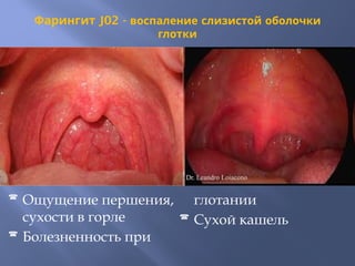 Фарингит J02 - воспаление слизистой оболочки
глотки
 Ощущение першения,
сухости в горле
 Болезненность при
глотании
 Сухой кашель
 