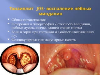 Тонзиллит J03- воспаление нёбных
миндалин
 Общая интоксикация
 Гиперемия и гипертрофия / отечность миндалин,
небных дужек, язычка, задней стенки глотки
 Боли в горле при глотании и в области воспаленных
л.у.
 Фолликулярные или лакунарные налеты
 