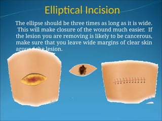 Elliptical Incision
The ellipse should be three times as long as it is wide.
This will make closure of the wound much easier. If
the lesion you are removing is likely to be cancerous,
make sure that you leave wide margins of clear skin
around the lesion.
 