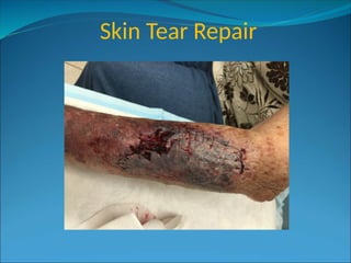 Skin Tear Repair
 