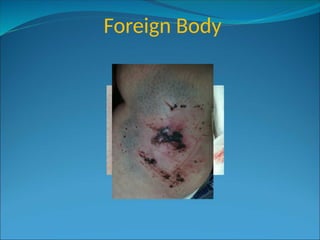 Foreign Body
 