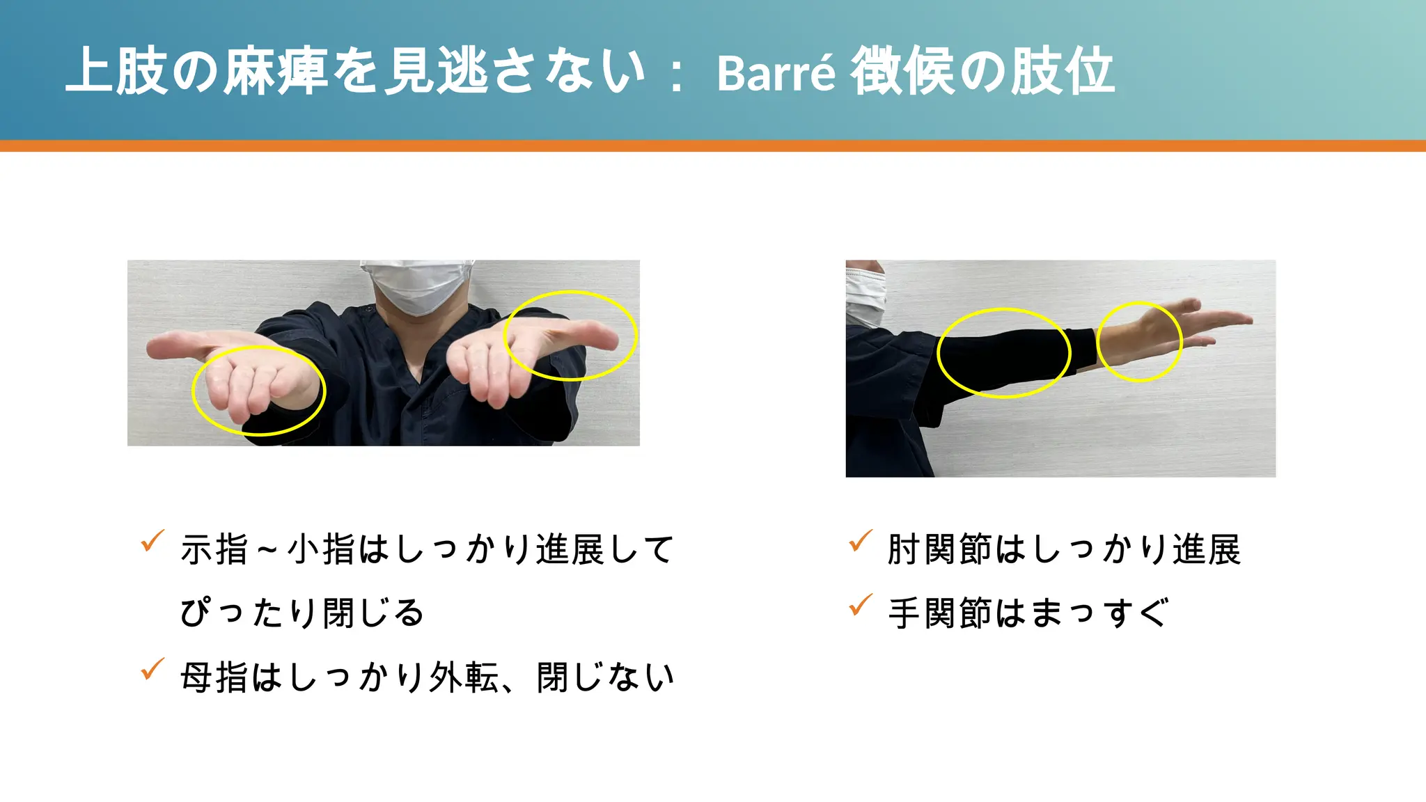  示指～小指はしっかり進展して
ぴったり閉じる
 母指はしっかり外転、閉じない
上肢の麻痺を見逃さない： Barré 徴候の肢位
 肘関節はしっかり進展
 手関節はまっすぐ
 