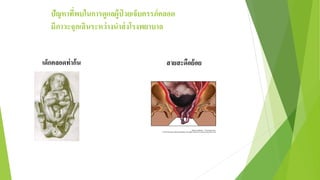 ปัญหาที่พบในการดูแลผู้ป่ วยเจ็บครรภ์คลอด
มีภาวะฉุกเฉินระหว่างนาส่งโรงพยาบาล
เด็กคลอดท่าก้น สายสะดือย้อย
 