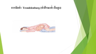 การจัดท่า Trendelenburg (ท่าศีรษะต่า ก้นสูง)
 