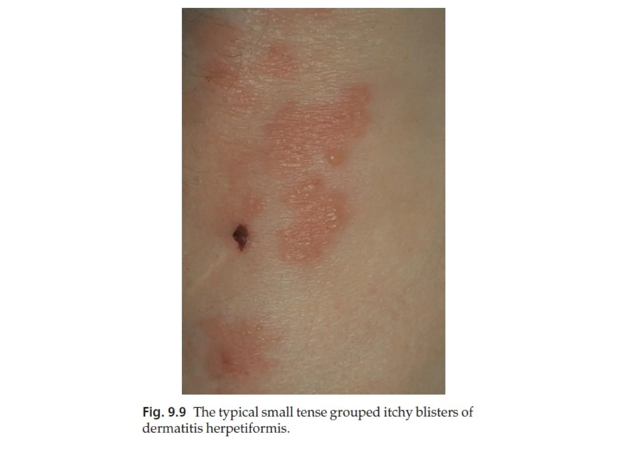 Bullous diseases Dermatology of 5th .pptx