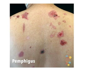 Bullous Process Bullous diseases Dermatology of 5th .pptx