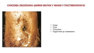 СЛИЗОВА ОБОЛОНКА ШИЙКИ МАТКИ У ЖІНКИ У ПОСТМЕНОПАУЗІ
• Бліда
• Суха
• Стоншена
• Піддатлива до травмувань
 