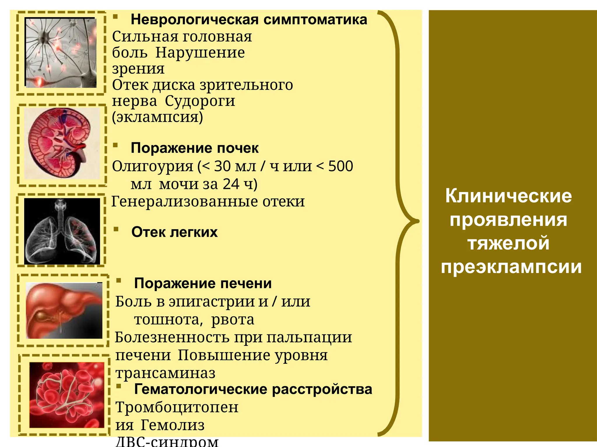 Клинические
проявления
тяжелой
преэклампсии
 Неврологическая симптоматика
Сильная головная
боль Нарушение
зрения
Отек диска зрительного
нерва Судороги
(эклампсия)
 Поражение почек
Олигоурия (< 30 мл / ч или < 500
мл мочи за 24 ч)
Генерализованные отеки
 Поражение печени
Боль в эпигастрии и / или
тошнота, рвота
Болезненность при пальпации
печени Повышение уровня
трансаминаз
 Гематологические расстройства
Тромбоцитопен
ия Гемолиз
 Отек легких
 