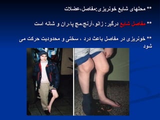 ‫عضالت‬،‫مفاصل‬:‫خونریزی‬ ‫شایع‬ ‫محلهای‬ **
‫عضالت‬،‫مفاصل‬:‫خونریزی‬ ‫شایع‬ ‫محلهای‬ **
**
**
‫شایع‬ ‫مفاصل‬
‫شایع‬ ‫مفاصل‬
‫است‬ ‫شانه‬ ‫و‬ ‫ران‬،‫پا‬ ‫مچ‬،‫آرنج‬،‫زانو‬ :‫درگیر‬
‫است‬ ‫شانه‬ ‫و‬ ‫ران‬،‫پا‬ ‫مچ‬،‫آرنج‬،‫زانو‬ :‫درگیر‬
‫می‬ ‫حرکت‬ ‫محدودیت‬ ‫و‬ ‫سختی‬ ، ‫درد‬ ‫باعث‬ ‫مفاصل‬ ‫در‬ ‫خونریزی‬ **
‫می‬ ‫حرکت‬ ‫محدودیت‬ ‫و‬ ‫سختی‬ ، ‫درد‬ ‫باعث‬ ‫مفاصل‬ ‫در‬ ‫خونریزی‬ **
‫شود‬
‫شود‬
 