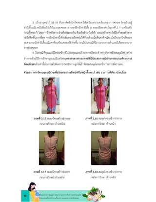 66 คูมือแนวทางการดูแลสุขภาพมารดาและทารกดวยการแพทยแผนไทย
ในระยะกอนตั้งครรภ ระยะตั้งครรภ ระยะคลอด ระยะหลังคลอด
3. เมื่ออายุครรภ 38-39 สัปดาหหรือใกลคลอด ใหเตรียมความพรอมของการคลอด โดยเรียนรู
ทาผีเสื้อมณีเวชไวเพื่อนำไปใชในระยะคลอด อาจลองฝกนั่งทาผีเสื้อ (รายละเอียดกลาวในบทที่ 2 การเตรียมตัว
กอนตั้งครรภ) โดยการนั่งหลังตรง ฝาเทาประกบกัน ดึงเทาเขามาใกลตัว แขนเหยียดตรงใชมือทั้งสองขางกด
เขาใหติดพื้นมากที่สุด การฝกนั่งทานี้เพื่อเพิ่มความยืดหยุนใหกับกลามเนื้อตนขาดานใน เมื่อถึงเวลาใกลคลอด
จะสามารถนั่งทาผีเสื้อมณีเวชเพื่อเตรียมคลอดไดงายขึ้น ยกเวนในกรณีที่มีภาวะรกเกาะต่ำและมีเลือดออกมาก
ทางชองคลอด
4. ในกรณีที่คุณแมมีโครงสรางที่ไมสมดุลและเกิดอาการผิดปกติ ควรทำการจัดสมดุลโครงสราง
รางกายดวยวิธีการรักษาแบบมณีเวชโดยบุคลากรทางการแพทยที่มีประสบการณผานการอบรมทักษะการ
จัดมณีเวชแลวเทานั้นในการทำหัตถการจัดปรับกระดูกใหเขาที่ตามสมดุลโครงสรางรางกายที่ตรวจพบ
ตัวอยาง การจัดสมดุลมณีเวชเพื่อรักษาอาการผิดปกติในหญิงตั้งครรภ เชน อาการแพทอง ปวดเมื่อย
ภาพที่ 3.15 สมดุลโครงสรางรางกาย
กอนการรักษา (ดานหนา)
ภาพที่ 3.16 สมดุลโครงสรางรางกาย
หลังการรักษา (ดานหนา)
ภาพที่ 3.17 สมดุลโครงสรางรางกาย
กอนการรักษา (ดานหลัง)
ภาพที่ 3.18 สมดุลโครงสรางรางกาย
หลังการรักษา (ดานหลัง)
 