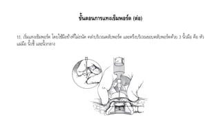 ขั้นตอนการแทงเข็มพอร์ต (ต่อ)
11. เริ่มแทงเข็มพอร์ต โดยใช้มือข้ำงที่ไม่ถนัด คลำบริเวณตลับพอร์ต และตรึงบริเวณขอบตลับพอร์ตด้วย 3 นิ้วมือ คือ หัว
แม่มือ นิ้วชี้ และนิ้วกลำง
 