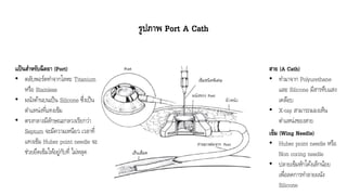 รูปภาพ Port A Cath
แป้นสาหรับฉีดยา (Port)
• ตลับพอร์ตทำจำกโลหะ Titanium
หรือ Stainless
• ผนังด้ำนบนเป็น Silicone ซึ่งเป็น
ตำแหน่งที่แทงเข็ม
• ตรงกลำงมีลักษณะกลวงเรียกว่ำ
Septum จะมีควำมเหนียว เวลำที่
แทงเข็ม Huber point needle จะ
ช่วยยึดเข็มให้อยู่กับที่ ไม่หลุด
สาย (A Cath)
• ทำมำจำก Polyurethane
และ Silicone มีสำรทึบแสง
เคลือบ
• X-ray สำมำรถมองเห็น
ตำแหน่งของสำย
เข็ม (Wing Needle)
• Huber point needle หรือ
Non coring needle
• ปลำยเข็มหักโค้งเล็กน้อย
เพื่อลดกำรทำลำยผนัง
Silicone
 