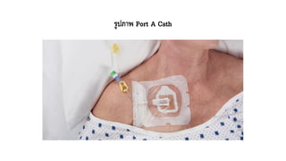 รูปภาพ Port A Cath
 