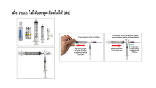 เมื่อ Flush ไม่ได้และดูดเลือดไม่ได้ (ต่อ)
 