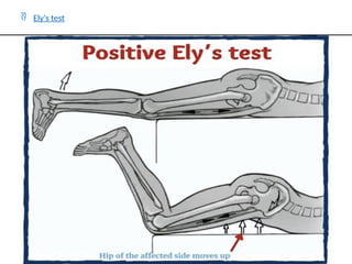  Ely's test
 