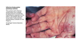 Endocarditis of heart tissue in cardiology.pptx