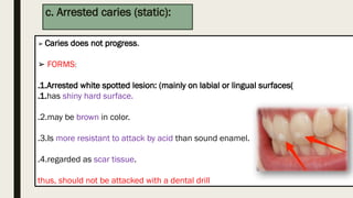 Static Caries Introduction to dental caries oral pathology | PPTX