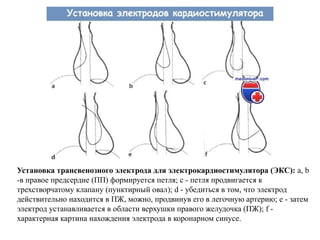 Установка трансвенозного электрода для электрокардиостимулятора (ЭКС): a, b
-в правое предсердие (ПП) формируется петля; с - петля продвигается к
трехстворчатому клапану (пунктирный овал); d - убедиться в том, что электрод
действительно находится в ПЖ, можно, продвинув его в легочную артерию; е - затем
электрод устанавливается в области верхушки правого желудочка (ПЖ); f -
характерная картина нахождения электрода в коронарном синусе.
 