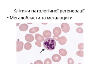 Клітини патологічної регенерації
• Мегалобласти та мегалоцити
 