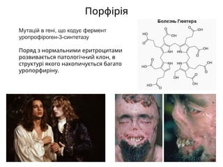 Порфірія
Мутацій в гені, що кодує фермент
уропрофіроген-3-синтетазу
Поряд з нормальними еритроцитами
розвивається патологічний клон, в
структурі якого накопичується багато
уропорфиріну.
 