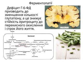 Ферментопатії
Дефіцит Г-6-ФД
призводить до
зменшення кількості
глутатіону, а це знижує
стійкість еритроциту до
перекисного окислення
і строк його життя.
 