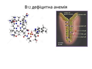 В12 дефіцитна анемія
 