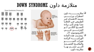 DOWN SYNDROME ‫داون‬ ‫متالزمة‬

‫داون‬ ‫ة‬###########‫متالزم‬
‫ي‬########‫ورث‬ ‫اضطراب‬
‫ر‬#‫غي‬ ‫ام‬#‫االنقس‬ ‫ببه‬#‫يس‬
‫ا‬#‫الخالي‬ ‫ي‬#‫ف‬ ‫بيعي‬#‫الط‬
‫زيادة‬ ‫ى‬#‫إل‬ ‫يؤدي‬ ‫ا‬#‫مم‬
‫و‬###‫أ‬ ‫ي‬###‫الكل‬ ‫خ‬###‫النس‬
‫ي‬#######‫ف‬ ‫ي‬#######‫الجزئ‬
‫الكروموسوم‬
21
.

‫المادة‬ ‫هذه‬ ‫بب‬##‫وتس‬
‫الزائدة‬ ‫ة‬########‫الوراثي‬
‫و‬###########‫النم‬ ‫تغيرات‬
‫دية‬##‫الجس‬ ‫ح‬##‫والمالم‬
‫ا‬####‫به‬ ‫م‬####‫تتس‬ ‫ي‬####‫الت‬
.‫داون‬ ‫متالزمة‬
 