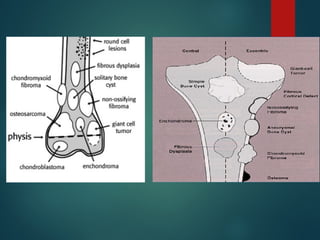 Comprehensive Overview of Bone Tumors: Classification, Diagnosis, and ...