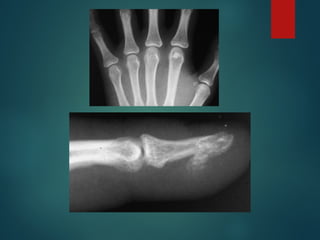 Comprehensive Overview of Bone Tumors: Classification, Diagnosis, and ...