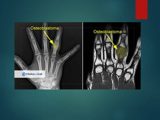 Comprehensive Overview of Bone Tumors: Classification, Diagnosis, and ...