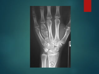 Comprehensive Overview of Bone Tumors: Classification, Diagnosis, and ...