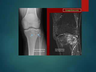 Comprehensive Overview of Bone Tumors: Classification, Diagnosis, and ...