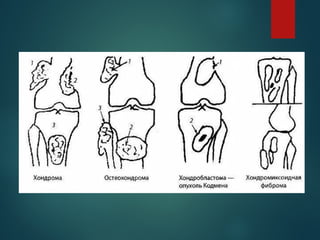 Comprehensive Overview of Bone Tumors: Classification, Diagnosis, and ...
