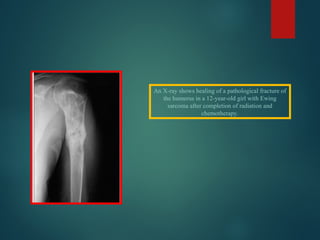 Comprehensive Overview of Bone Tumors: Classification, Diagnosis, and ...
