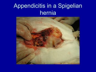 Porcelain Appendix Comprehensive Overview of Appendicitis: Diagnosis, Treatment, and ...