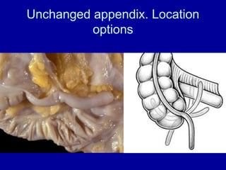 Comprehensive Overview of Appendicitis: Diagnosis, Treatment, and ...