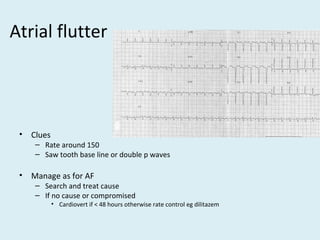Atrial flutter
• Clues
– Rate around 150
– Saw tooth base line or double p waves
• Manage as for AF
– Search and treat cause
– If no cause or compromised
• Cardiovert if < 48 hours otherwise rate control eg dilitazem
 